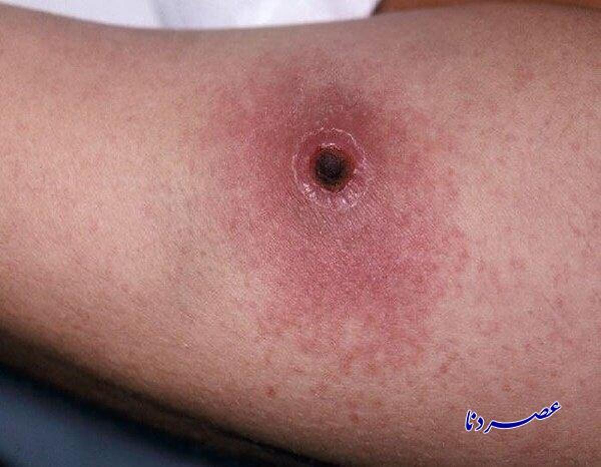 شناسایی دو مورد ابتلا به بیماری سیاه زخم در بویراحمد