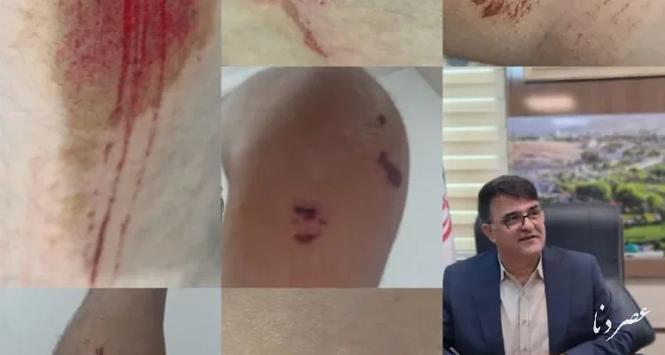 حمله سگ ولگرد به نوجوان در کمربندی ساحلی یاسوج؛ شهرداری پاسخ دهد